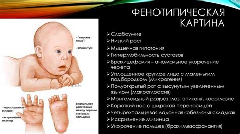 Синдром Дауна - презентация онлайн
