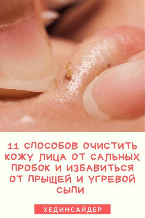 11 способов очистить кожу лица от сальных пробок и избавиться от прыщей ...