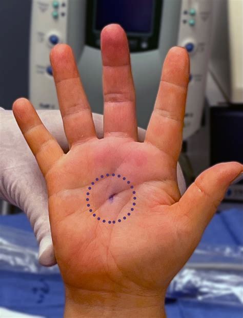 Photos Of Trigger Finger Surgery at Kristian Christenson blog