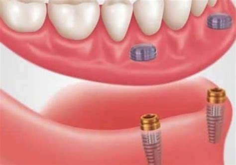 The Pros and Cons of Snap-On Dentures: A Comprehensive Comparison to ...