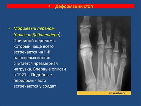 Деформация стопы - презентация онлайн
