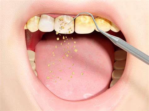 Oral Bacteria and Brain Abscesses - Dent Ally