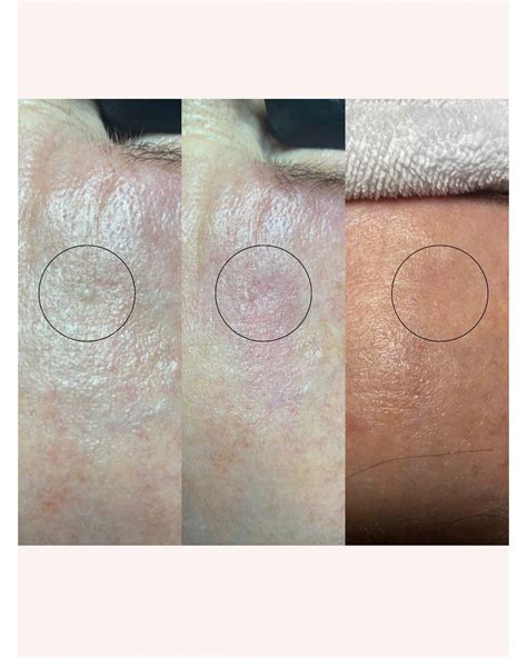MAK Esthetics - -Milia Extraction- Before • Right After... | Facebook