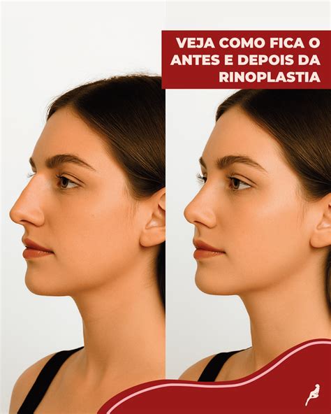 Quanto Tempo Depois Da Rinoplastia Posso Assoar O Nariz