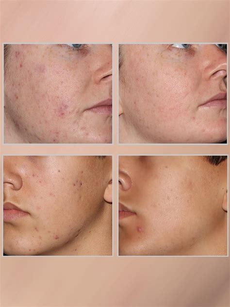 acne laser treatment renew skin care center