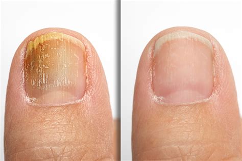 The Role of Antifungal Medication in Treating Toenail Fungus – Healthy