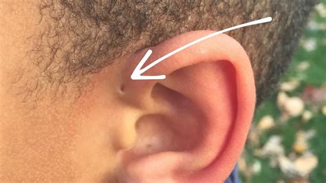 Preauricular sinus, pit or cyst causes, symptoms, diagnosis & treatment