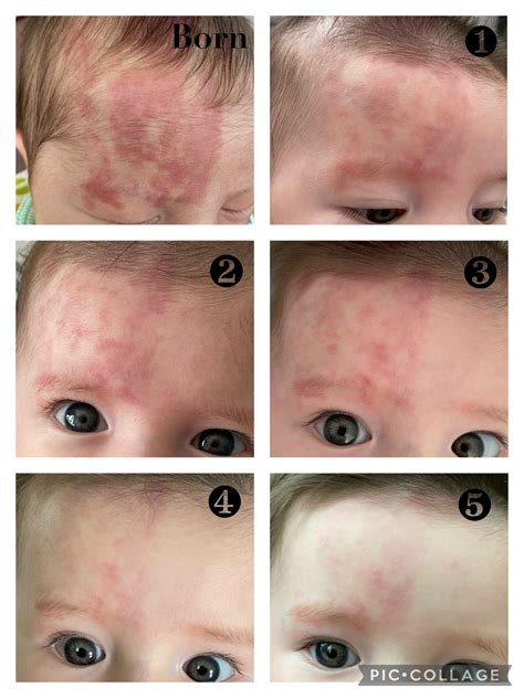 Honolulu, HI Lasers for Skin Treatments by Dermatologist