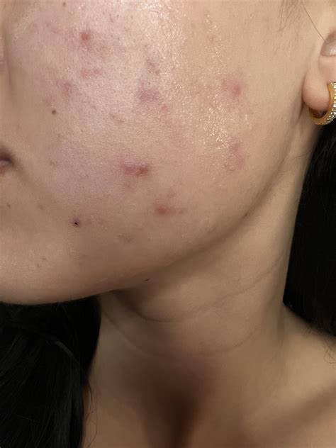 Is this fungal acne? : r/Fungalacne