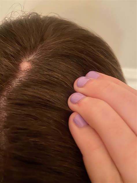 Could this be a Pilar Cyst? I’ve had it for years and it does not hurt