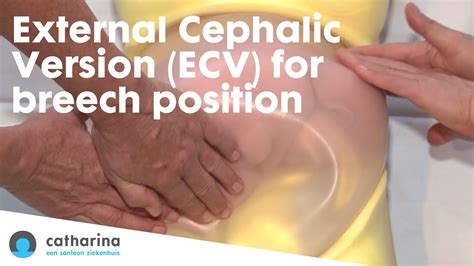 External Cephalic Version (ECV) for breech position at Catharina ...