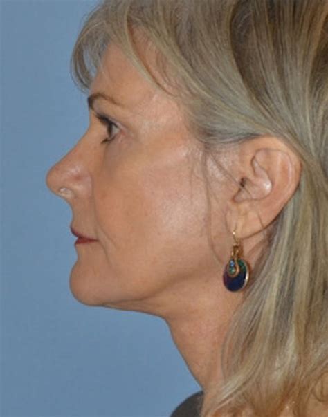 Patient 301269 | Lower Face & Neck Lift Before & After Photos ...