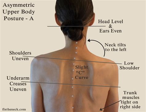 One Shoulder Higher Than The Other Neck Pain - mapasgmaes