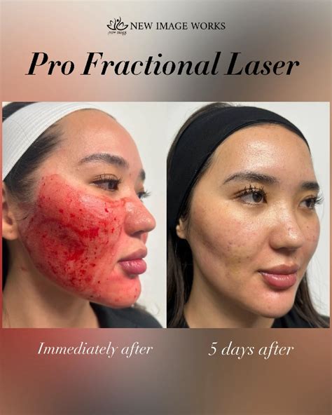profractional laser acne scar scar revision solution