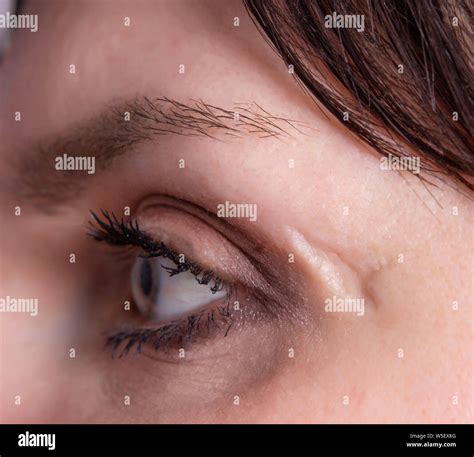 Eye pimple hi-res stock photography and images - Alamy