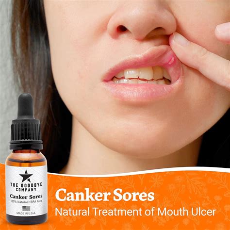 Canker Sore Treatment Serum - Effective Mouth Ulcer Relief (30 mL