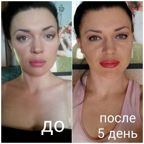 Ботокс Губ Цена Фото — Фото Картинки