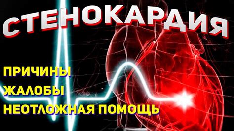 Стенокардия напряжения - проявление и неотложная помощь - YouTube