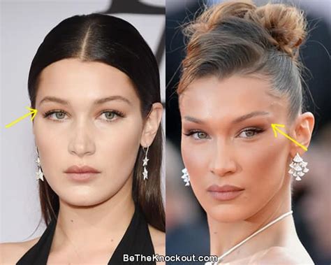 Bella Hadid Plastic Surgery Comparison Photos
