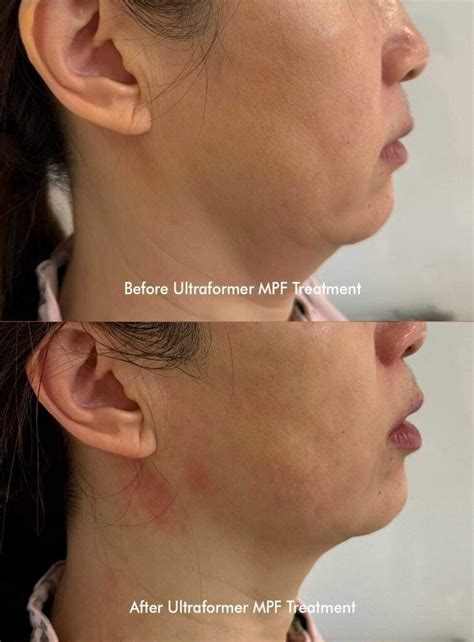 ultraformer mpt sydney  surgical skin tightening treatment
