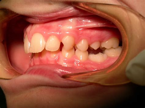 Ortodonzia pediatrica - Smile Medical Center