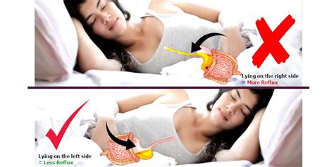 home remedies  heartburn quicker acid reflux recovery