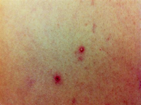 Melioidosis