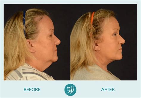 Indianapolis Skin Resurfacing Before & After Photos | Winslow Facial ...
