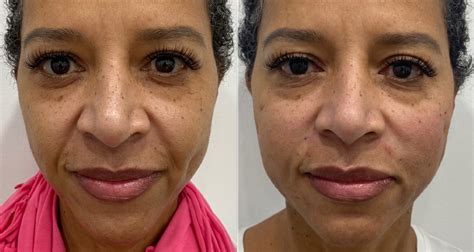 Face Threading Lift Procedure at Jenna Johnson blog