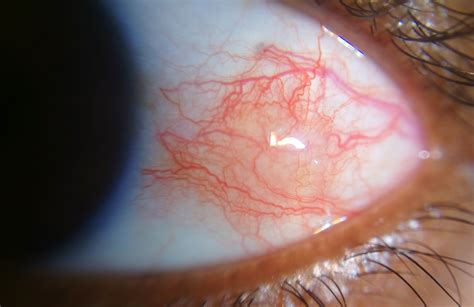 Episcleritis - EyeWiki