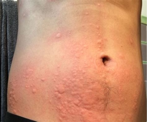 Orticaria - Dermatologia e venereologia - Medicascientia