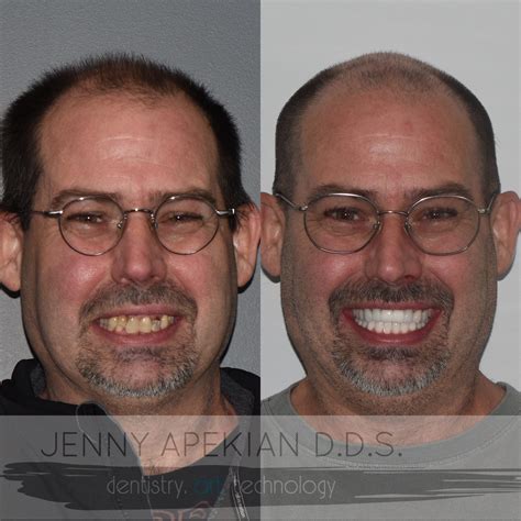 Implants with Bridges Before & After - Midtown Dental - Sacramento, CA