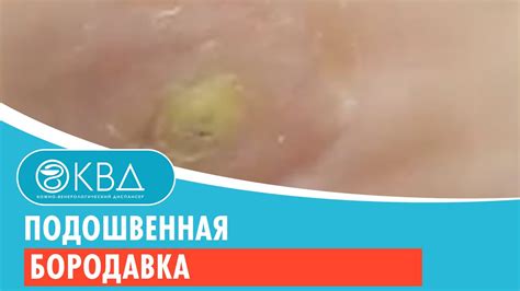 Подошвенная бородавка. Клинический случай №57 - YouTube