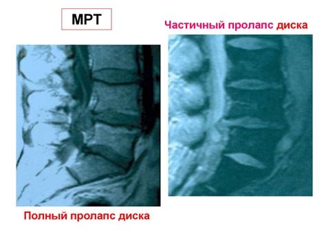 Дегенеративно-дистрофические заболевания позвоночника (ДЗП ...