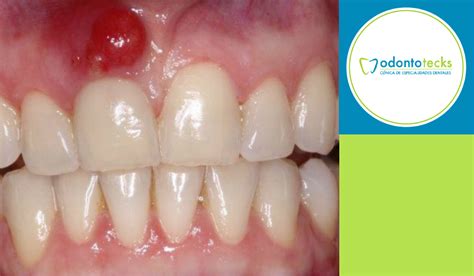 Qu Es Un Absceso Dental Las Causas Del Absceso Gingival Fotos | The ...