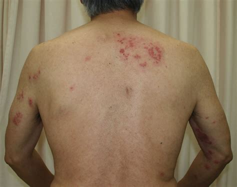 Photo De Stock De Herpes Zoster Viral Disease Infecti - vrogue.co