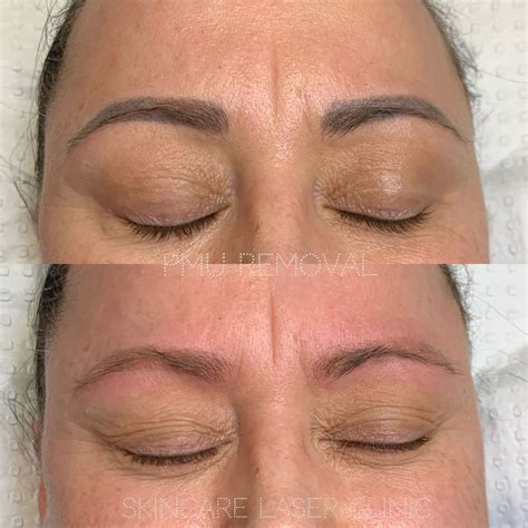 tattoo removal clinic near me 2