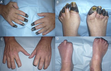 Vasopressor-induced peripheral skin necrosis after shock | Revista