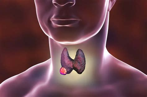 Thyroid Removal Surgery (Thyroidectomy)
