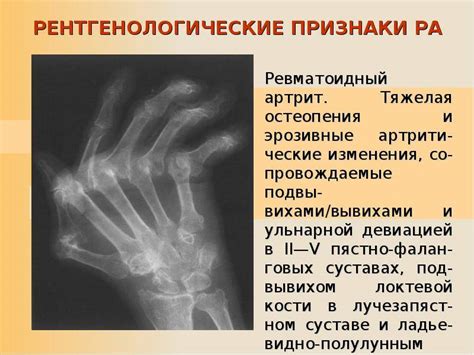 Диагностика псориатического артрита - рентген и другие методы исследования