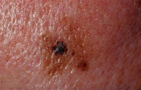 Melanoma in situ photos | Symptoms and pictures