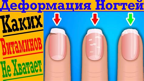 Деформация, расслоение ногтей! Каких витаминов не хватает?! - YouTube