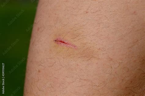 open wound   leg caused   scratch bruises  blackness