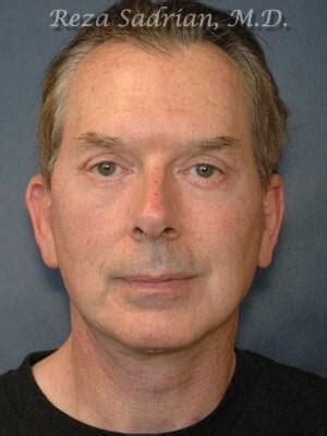 Facial Plastic Surgery for Men Before and Afters | Dr. Sadrian