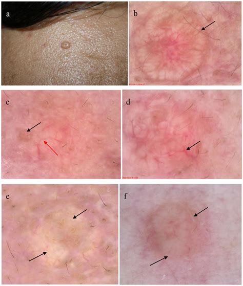 Patient with sebaceous gland hyperplasia (SGH) on the face (a