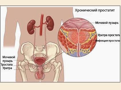 Биопрост свечи: отзывы, фармакологическое действие