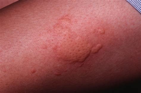 stress rashes   symptoms  hives jftu