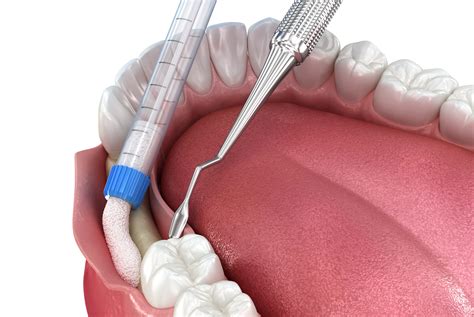 Understanding Bone Grafting: What Is It and When Is It Necessary