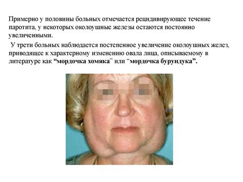 Синдром Шегрена - презентация онлайн