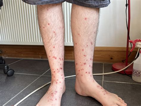 Severe Bed Bug Bites